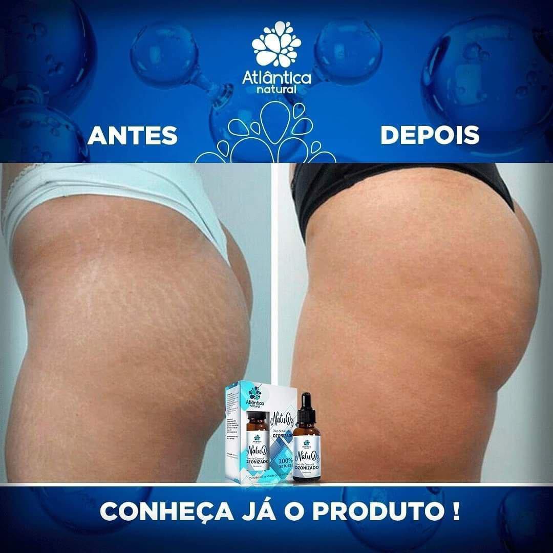 Resultado tratamento de estrias