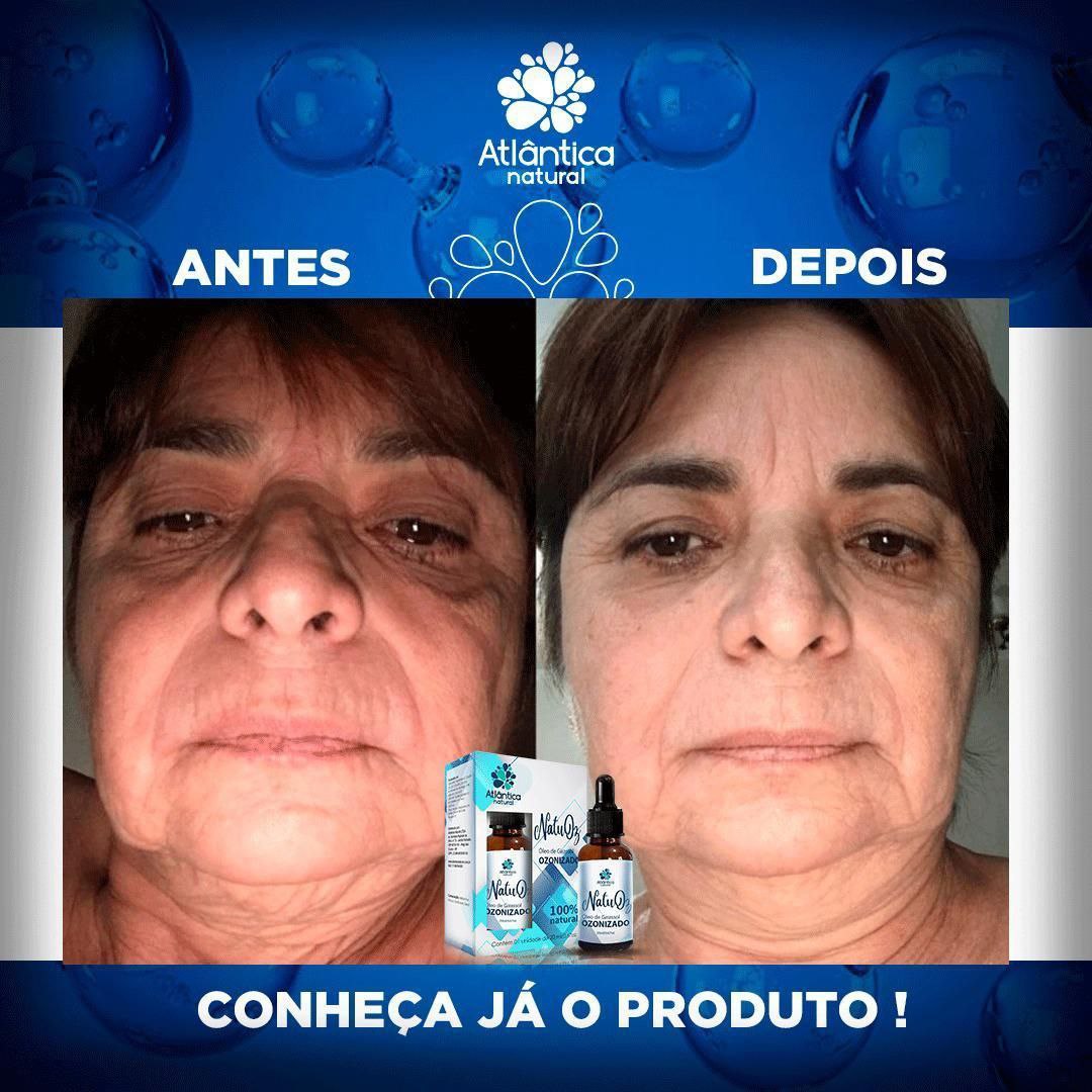 Resultado flacidez facial