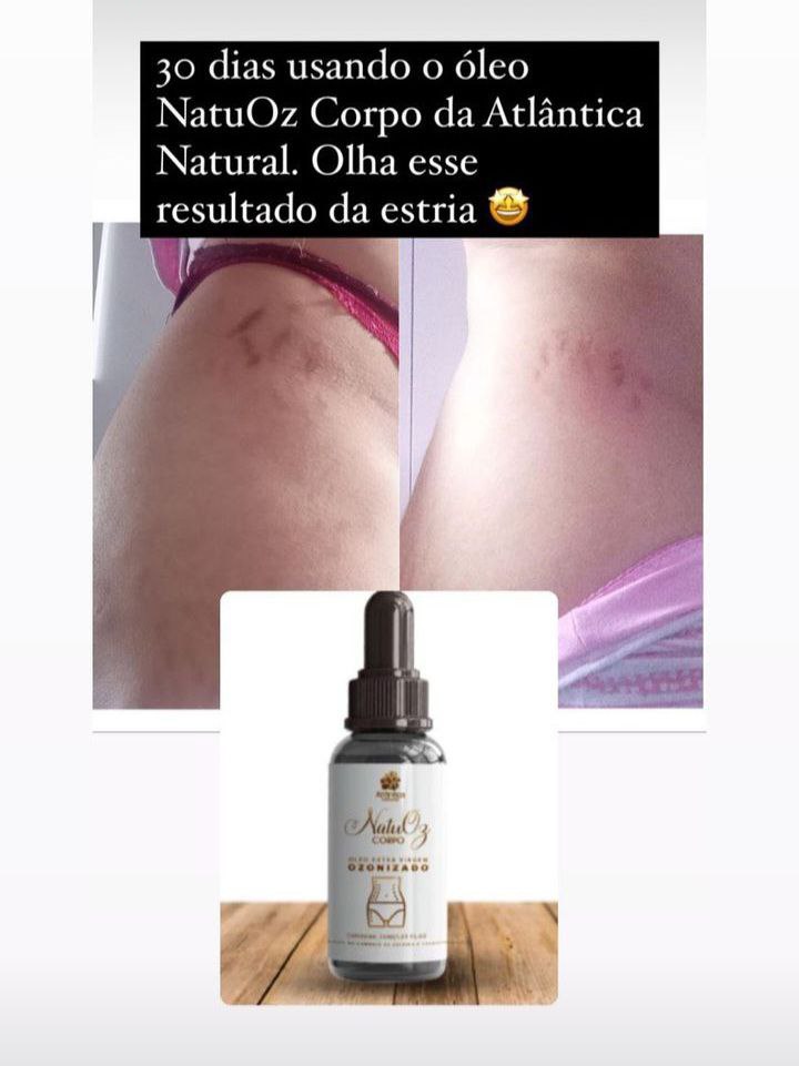 Resultado estrias antes e depois