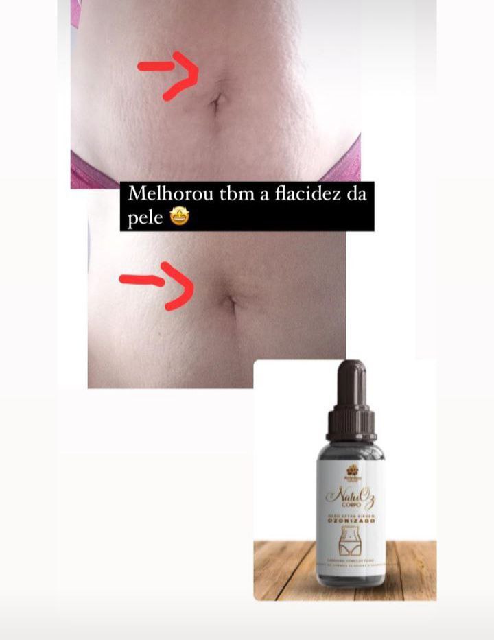 Resultado flacidez abdominal