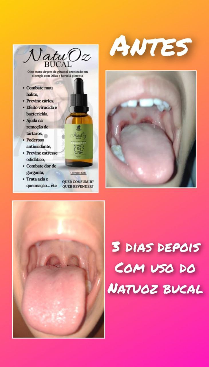 Tratamento de inflamação gengival
