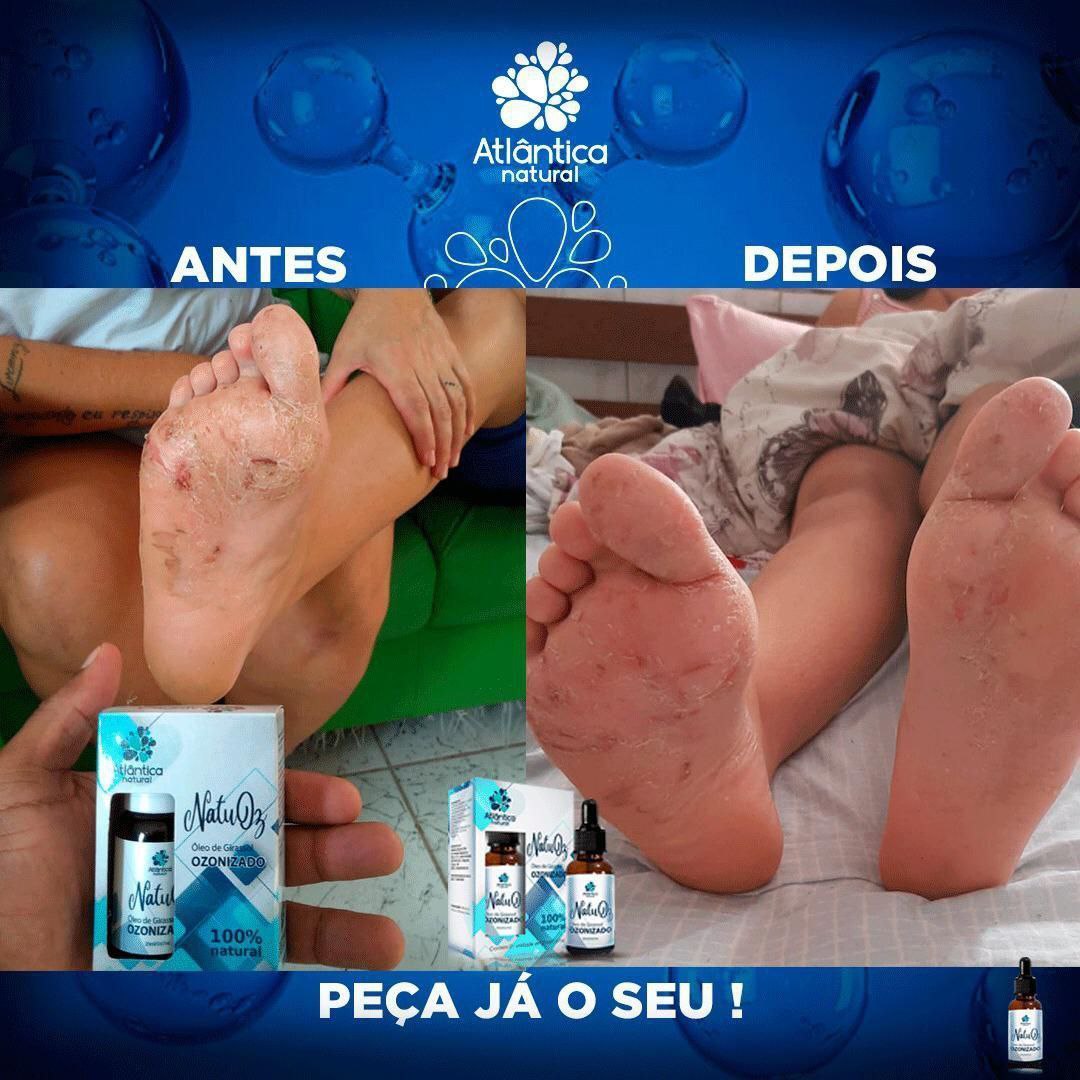 Tratamento de escara plantar