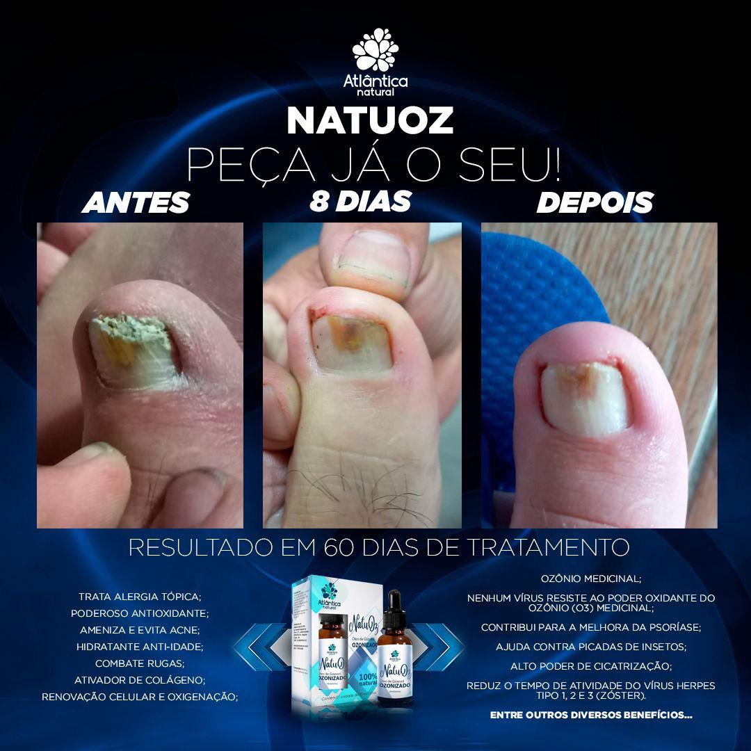 Tratamento de micose na unha