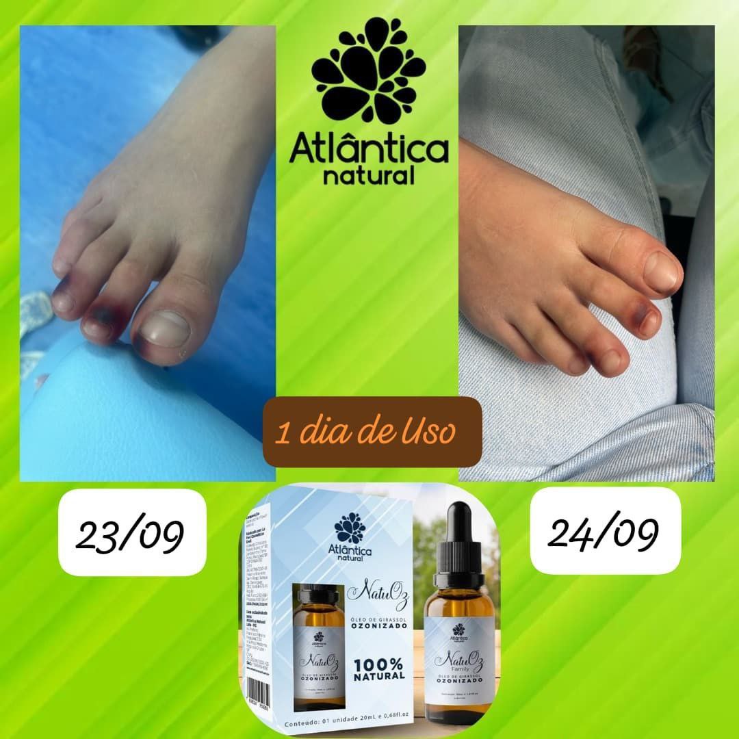 Tratamento pé atópico