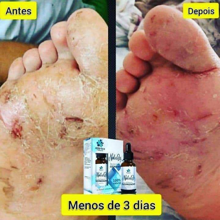 Tratamento foliculite nos pés