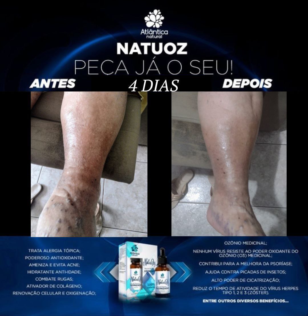 Tratamento insuficiência venosa